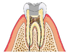 むし歯｜う蝕C2治療例
