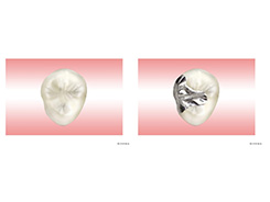 むし歯｜う蝕C2治療例