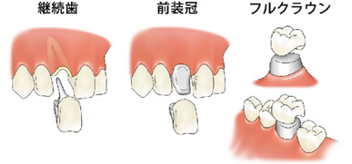 むし歯｜クラウン