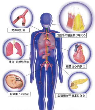 メンテナンス｜お口の細菌の体への影響を図に示した画像