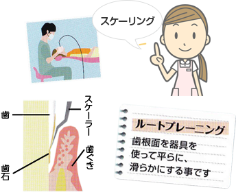メンテナンス｜プラークコントロール4