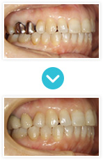 白い歯｜セラミック・クラウン