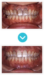 白い歯｜歯の変色