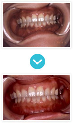 白い歯｜歯ぐきの変色