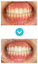 白い歯｜ホワイトニング